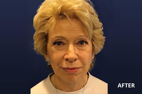 Buccal Fat Removal After Buccal Fat Removal After