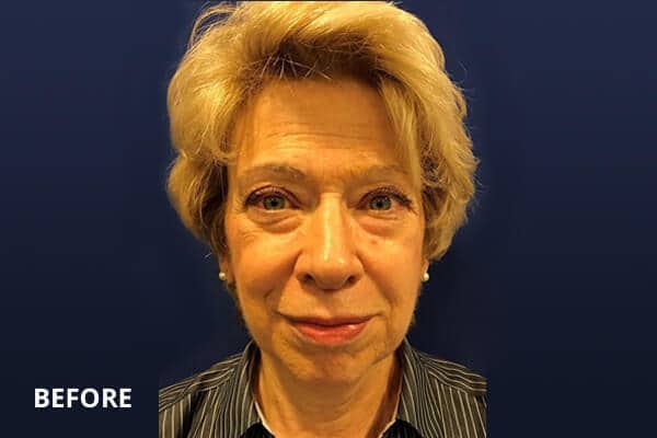 Buccal Fat Removal Before Buccal Fat Removal Before