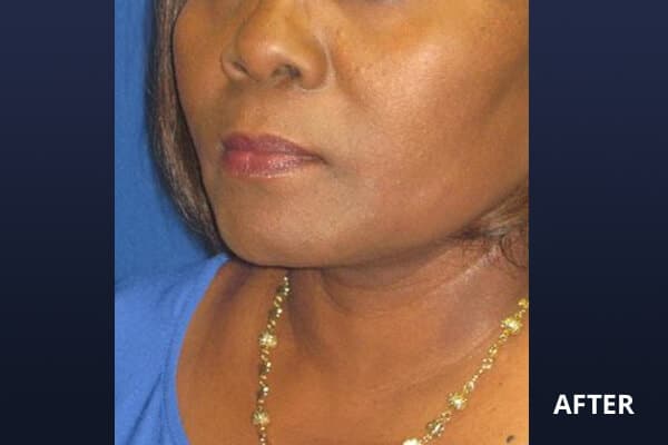 facelift after facelift after