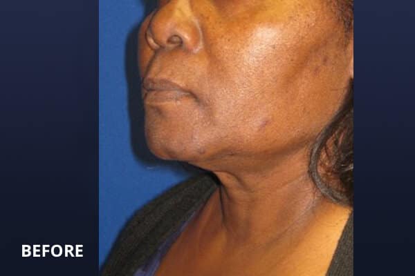 facelift before facelift before
