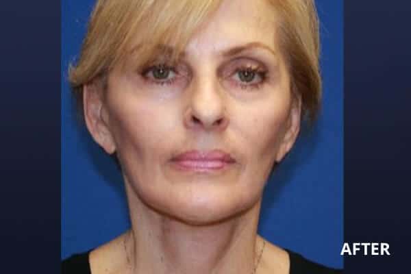 Facelift Before and After Pictures Long Island & Manhattan, NY