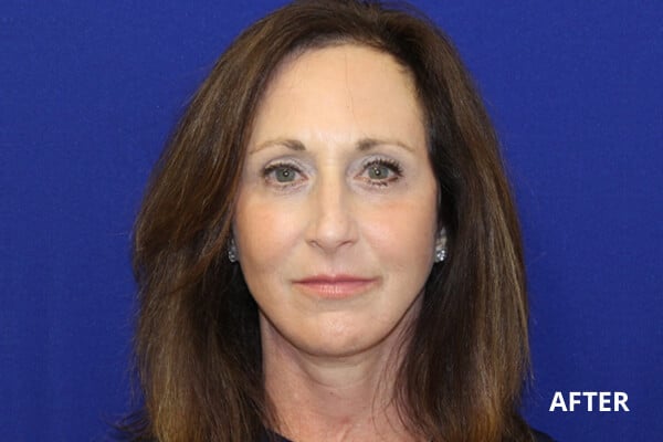 Face lift after Face lift after