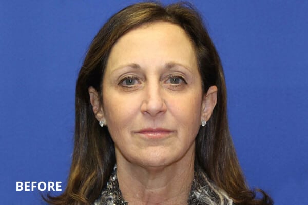 Face lift Before Face lift Before