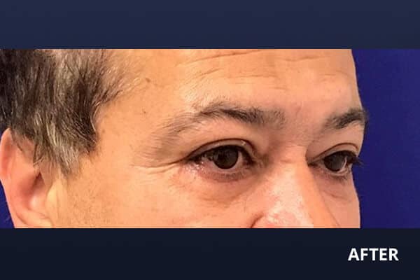 Lower Blepharoplasty After Lower Blepharoplasty After