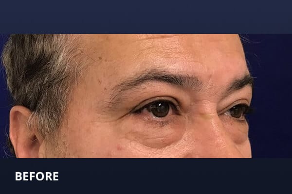Lower Blepharoplasty Before Lower Blepharoplasty Before