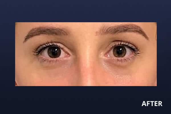 Lower Blepharoplasty After Lower Blepharoplasty After