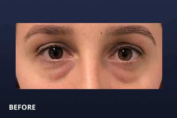 Lower Blepharoplasty Before Lower Blepharoplasty Before