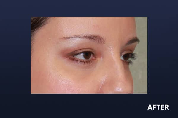 Lower Blepharoplasty After Op Lower Blepharoplasty After Op