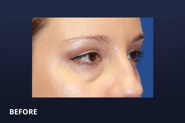 Lower Blepharoplasty Before Operation Lower Blepharoplasty Before Operation