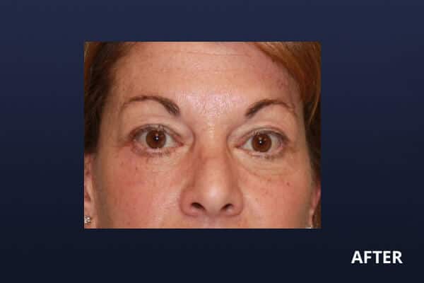 Lower Blepharoplasty After Lower Blepharoplasty After