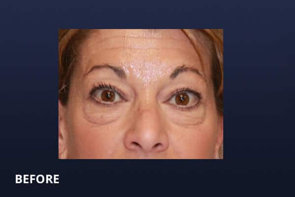 Lower Blepharoplasty Before Lower Blepharoplasty Before