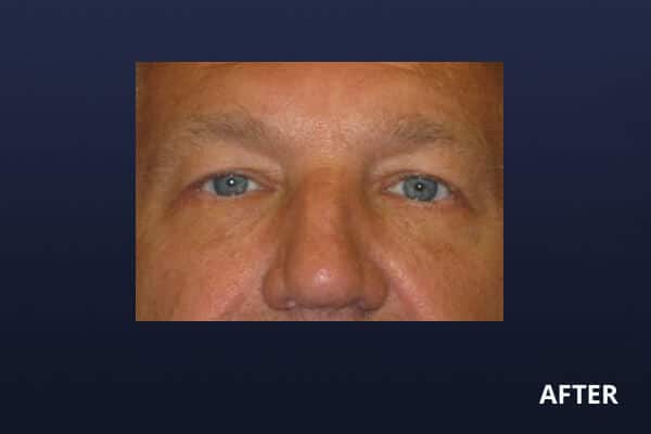 Lower Blepharoplasty Before Lower Blepharoplasty Before