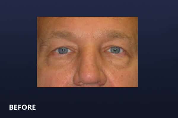 Lower Blepharoplasty Before Lower Blepharoplasty Before