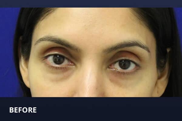 Lower Blepharoplasty Before Lower Blepharoplasty Before