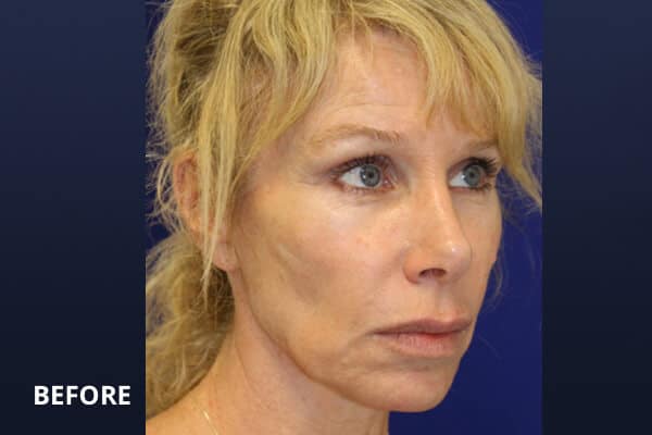Minilift before Minilift before