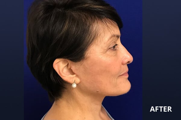 Necklift Before and After Pictures Long Island & Manhattan, NY Necklift Before and After Pictures Long Island & Manhattan, NY