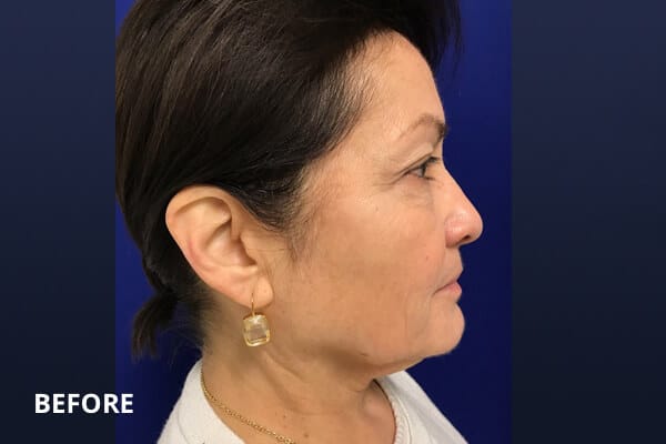 Necklift Before and After Pictures Long Island & Manhattan, NY Necklift Before and After Pictures Long Island & Manhattan, NY