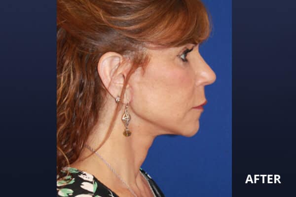Necklift Before and After Pictures Long Island & Manhattan, NY Necklift Before and After Pictures Long Island & Manhattan, NY