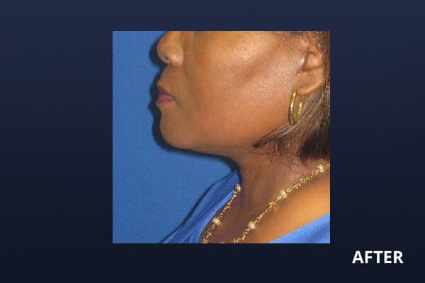 Necklift Before and After Pictures Long Island & Manhattan, NY Necklift Before and After Pictures Long Island & Manhattan, NY