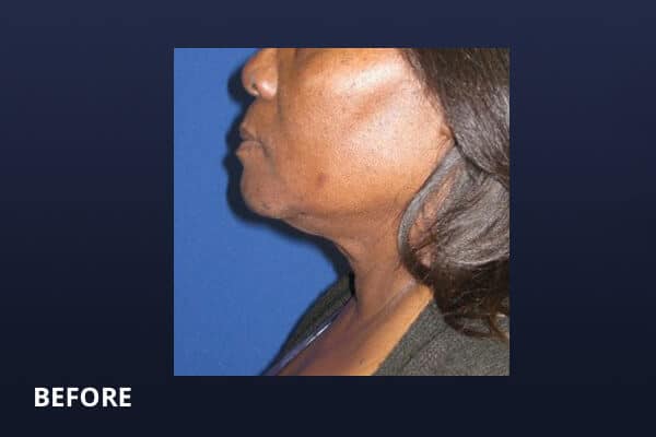 Necklift Before and After Pictures Long Island & Manhattan, NY Necklift Before and After Pictures Long Island & Manhattan, NY