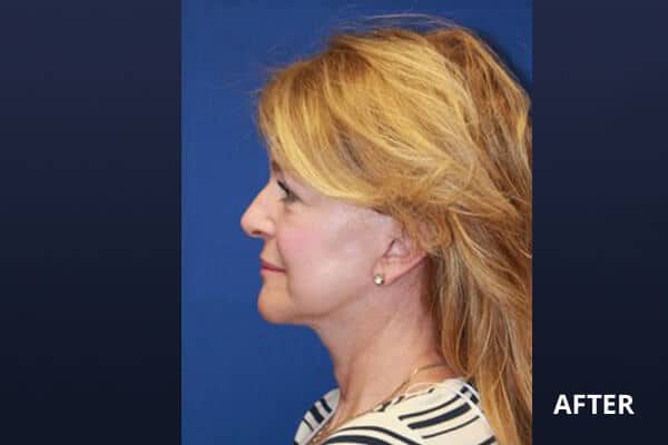 Necklift Before and After Pictures Long Island & Manhattan, NY