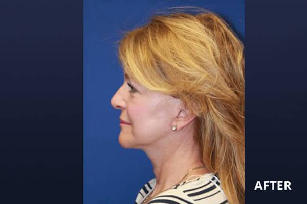 Necklift Before and After Pictures Long Island & Manhattan, NY Necklift Before and After Pictures Long Island & Manhattan, NY