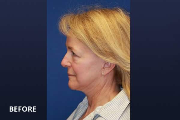Necklift Before and After Pictures Long Island & Manhattan, NY Necklift Before and After Pictures Long Island & Manhattan, NY