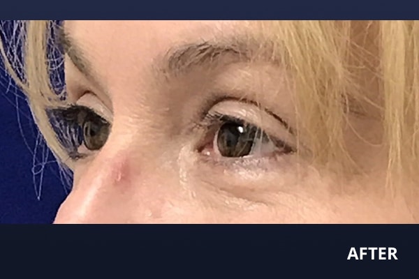 Upper Blepharoplasty After Upper Blepharoplasty After