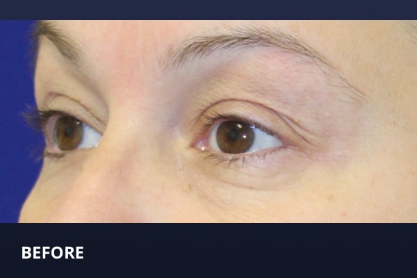 Upper Blepharoplasty Before Upper Blepharoplasty Before