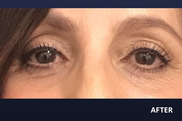 Upper Blepharoplasty After Upper Blepharoplasty After