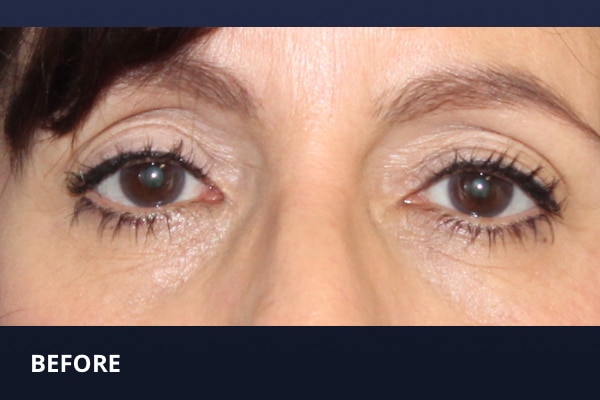 Upper Eyelid Before and After Pictures Long Island & Manhattan, NY