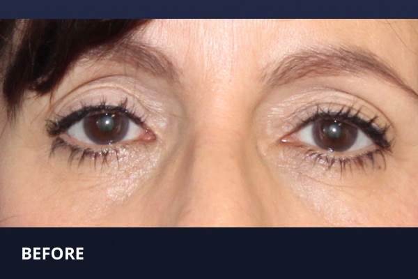 Upper Blepharoplasty Before Upper Blepharoplasty Before