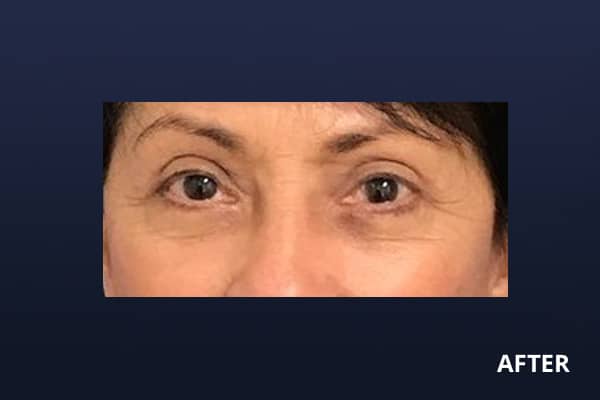 Upper Blepharoplasty After Upper Blepharoplasty After