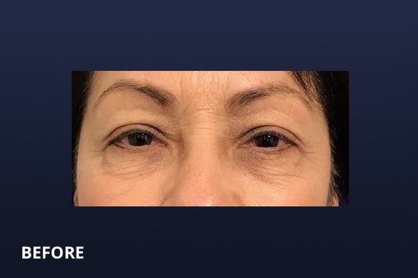 Upper Blepharoplasty Before Upper Blepharoplasty Before