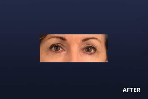 Upper Blepharoplasty After Upper Blepharoplasty After