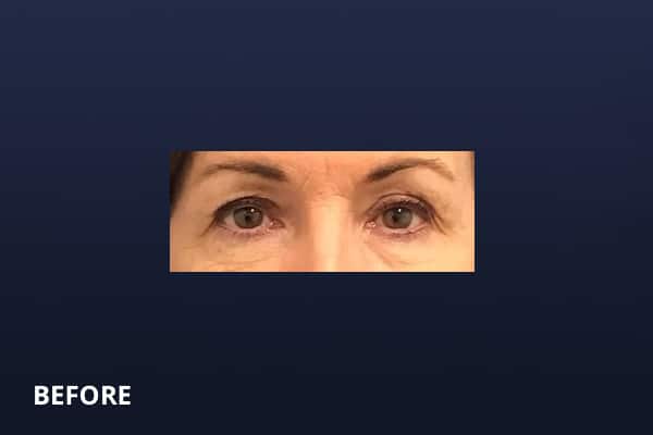 Upper Blepharoplasty Before Upper Blepharoplasty Before