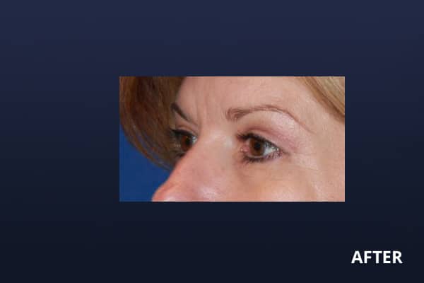 Upper Blepharoplasty After Upper Blepharoplasty After
