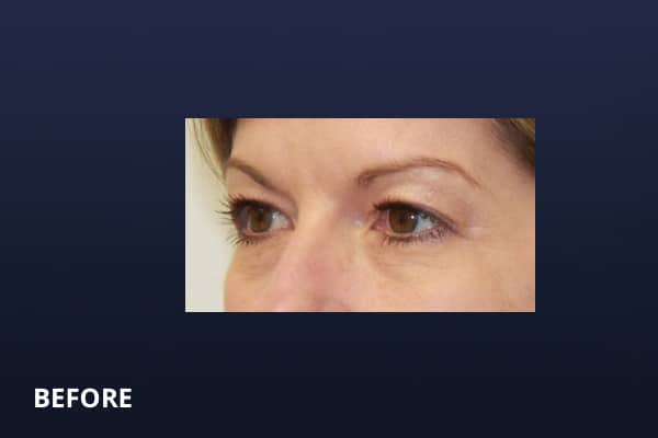 Upper Blepharoplasty Before Upper Blepharoplasty Before