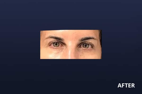 Upper Blepharoplasty After Upper Blepharoplasty After