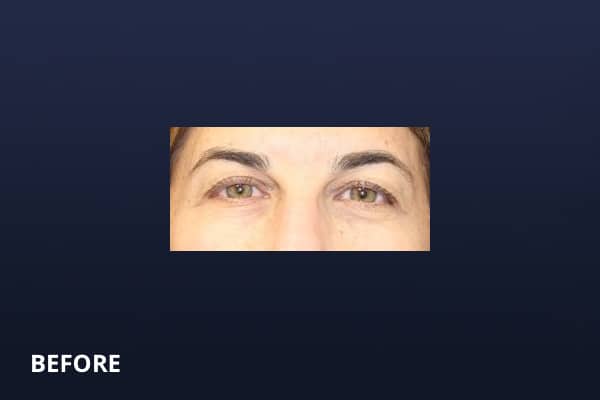 Upper Blepharoplasty Before Upper Blepharoplasty Before