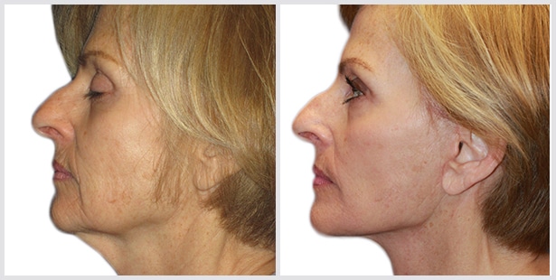 Facelift Before and After Pictures Long Island & Manhattan, NY