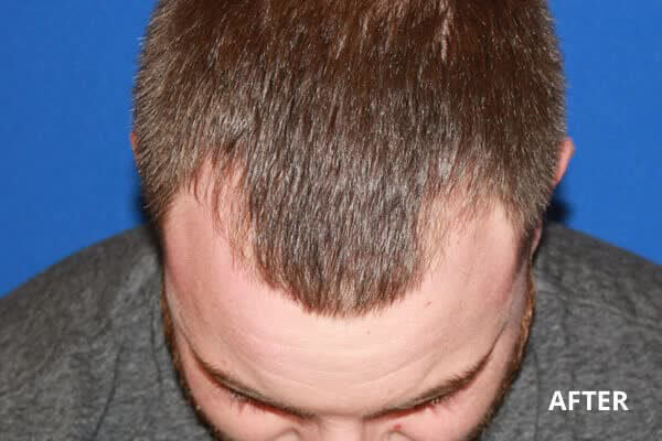 PRP Hair Restoration Before and After Pictures Long Island & Manhattan, NY