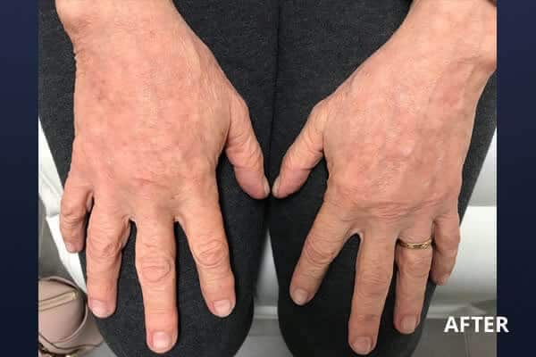 Hand Rejuvenation Before and After Pictures Long Island & Manhattan, NY