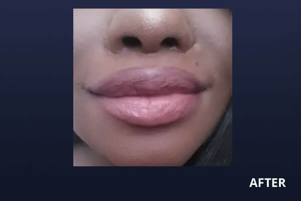 Lip Lift After Lip Lift After