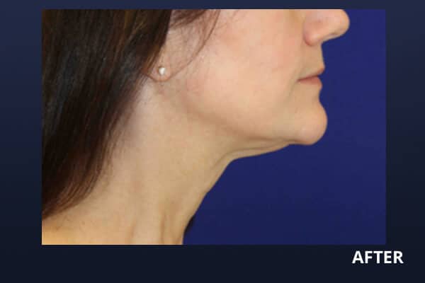 Kathleen After Ultherapy Kathleen After Ultherapy