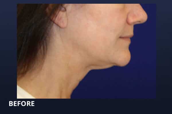 Kathleen before Ultherapy Kathleen before Ultherapy