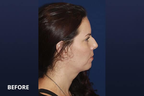 Liquid Rhinoplasty Before and After Pictures Long Island & Manhattan, NY