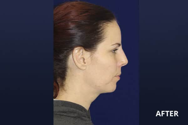 Liquid Rhinoplasty Before and After Pictures Long Island & Manhattan, NY Liquid Rhinoplasty Before and After Pictures Long Island & Manhattan, NY