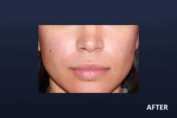 Mole Removal Before and After Pictures Long Island & Manhattan, NY