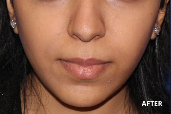 Buccal Fat Removal Before and After Pictures Long Island & Manhattan, NY
